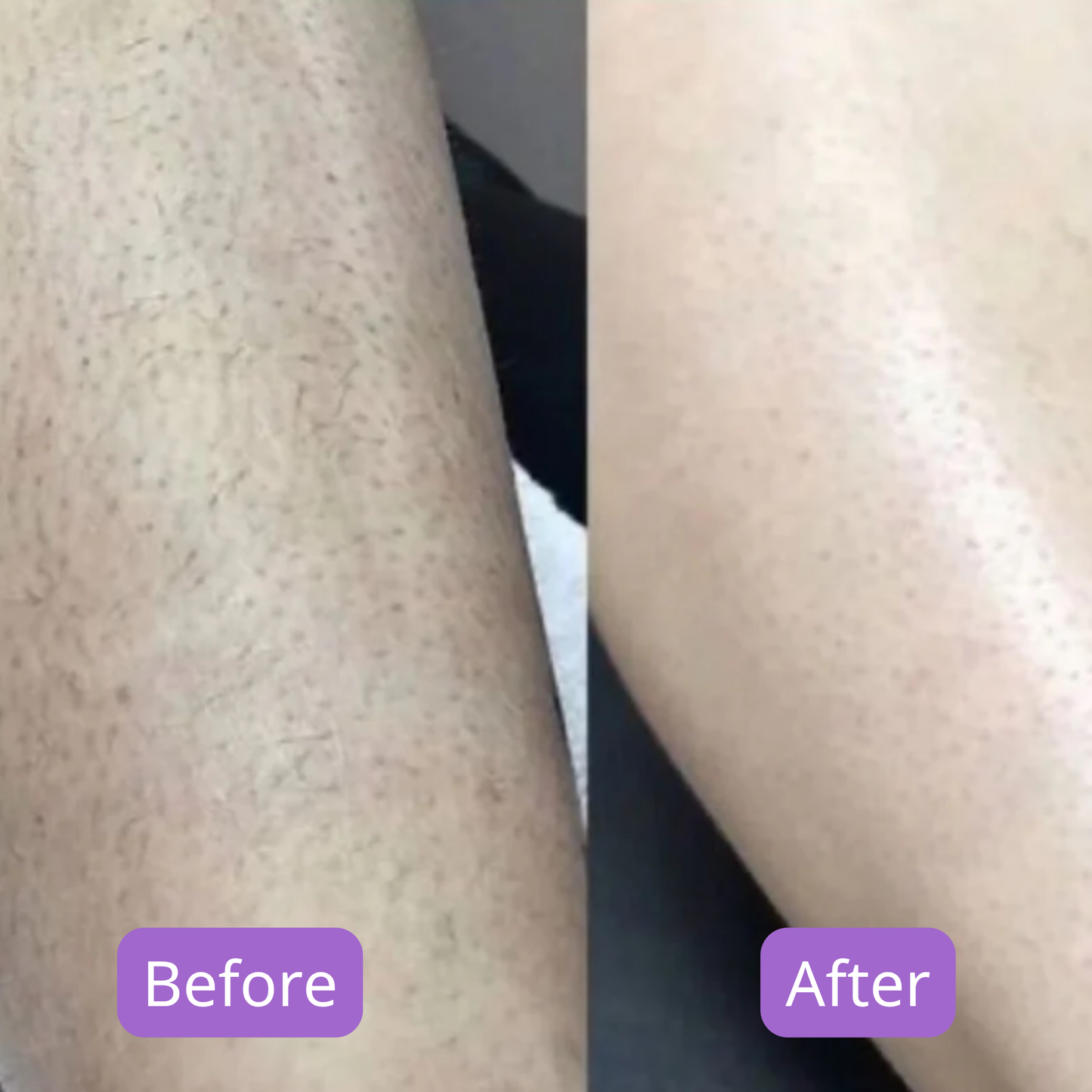 Before and after comparison of a person's leg with visible hair removal.